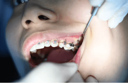Brace